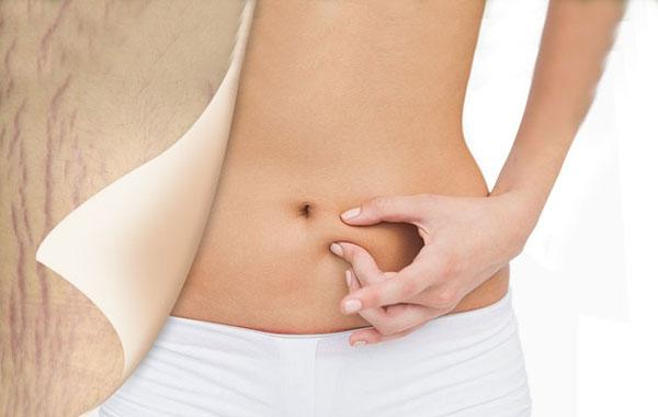 产后再用疤复平祛妊娠纹有用吗,产后怎么祛妊娠纹最有效的方法