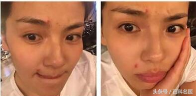 嘴巴周围长闭口粉刺痘痘怎么消除,痘痘长在嘴巴周围是什么原因