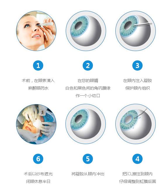 icl晶体植入视力恢复过程,icl手术方法