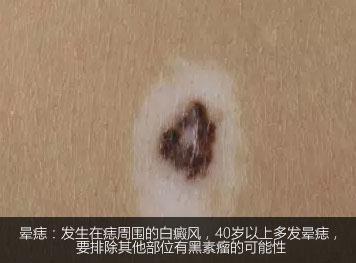不是白癜风的白斑能查出是什么吗,不是白癜风的白点是啥
