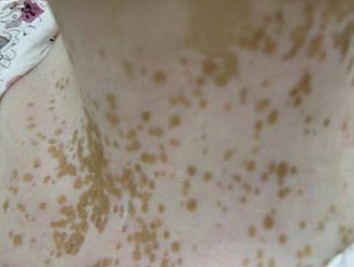 介入治白癜风与细胞培植一样吗,手指白癜风适合细胞培植吗