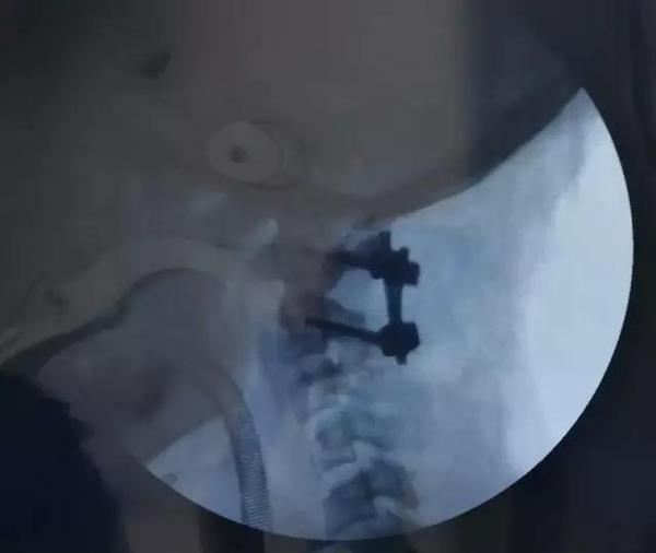 寰枢椎脱位手术适应症,寰枢椎脱位手术最广泛麻醉方法