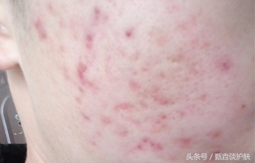 痘坑痘疤做什么手术才能去除,如何去除痘疤痘印痘坑