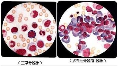 五十多岁老阿姨贫血吃什么,老年人贫血一查竟是癌症
