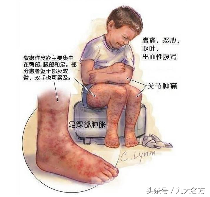 腹型过敏性紫癜中医能治愈吗,色素性紫癜性皮肤病中医治疗