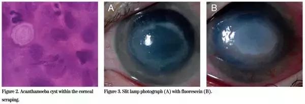 戴隐形眼镜洗手没有洗手液,隐形眼镜被水泡过不好戴了