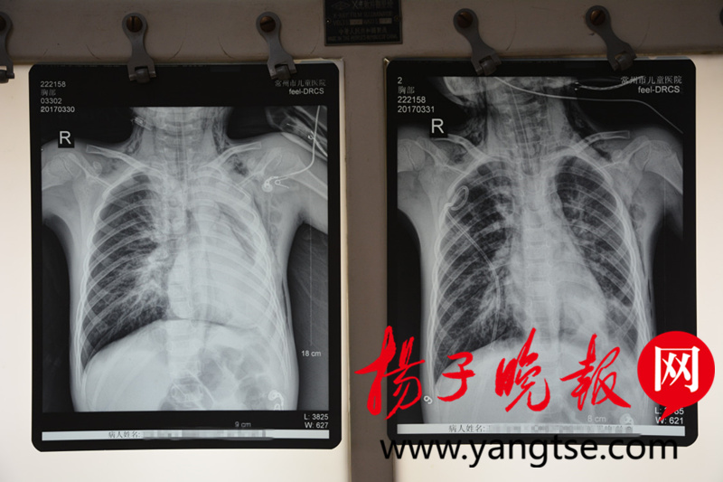 小孩肺炎挂水7天流黄鼻涕,8岁男童感冒反复高烧烧4天怎么办