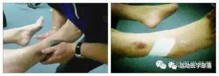 崴脚了四个多月反复不好,崴脚反复扭伤中医怎么治