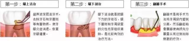 牙周病的五种治疗方法,牙周病的最佳治疗方法