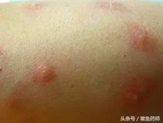 愁人的*麻疹荨**,下次带娃去医院之前一定要看看