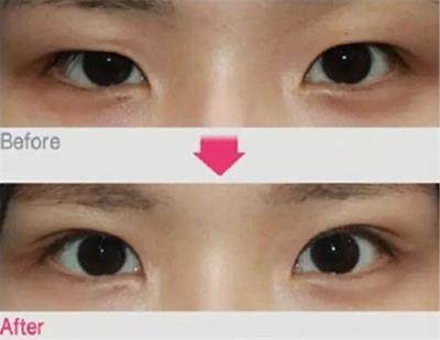 眼睛小怎么办单眼皮,眼睛小怎么办变大