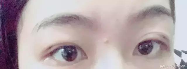 真实贴双眼皮贴,单眼皮怎么贴第二天变双眼皮