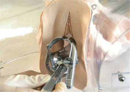 女性刮宫后一直疼痛怎么办,女人做了刮宫术发热