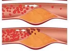 血管衰老怎么补充营养,血管衰老保健案例