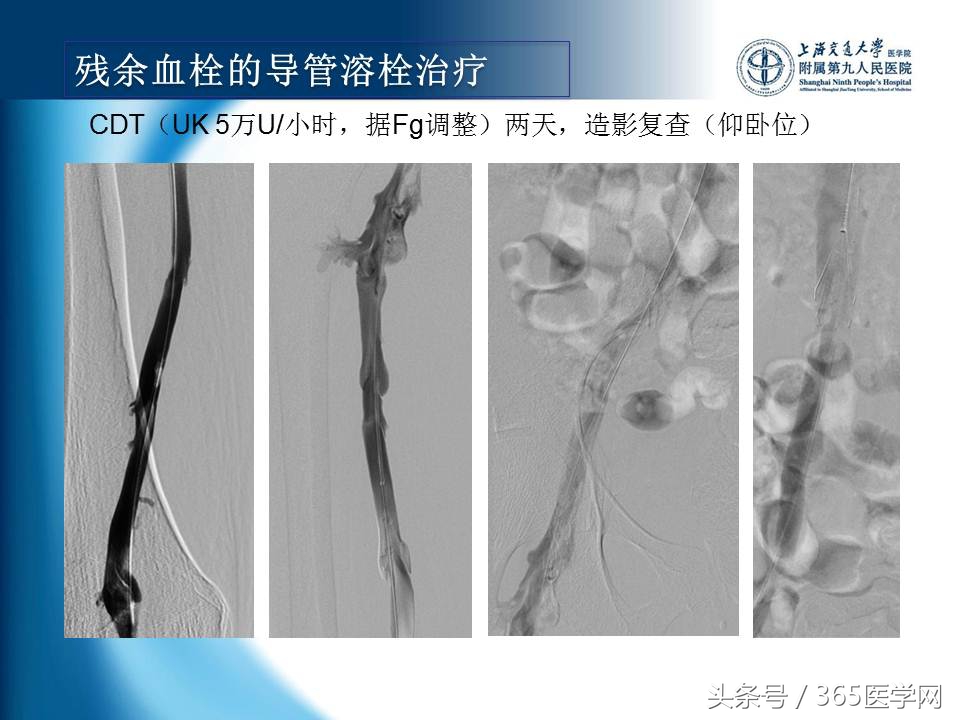 下肢静脉血栓植入滤器后的护理,下肢静脉血栓滤器植入后注意事项
