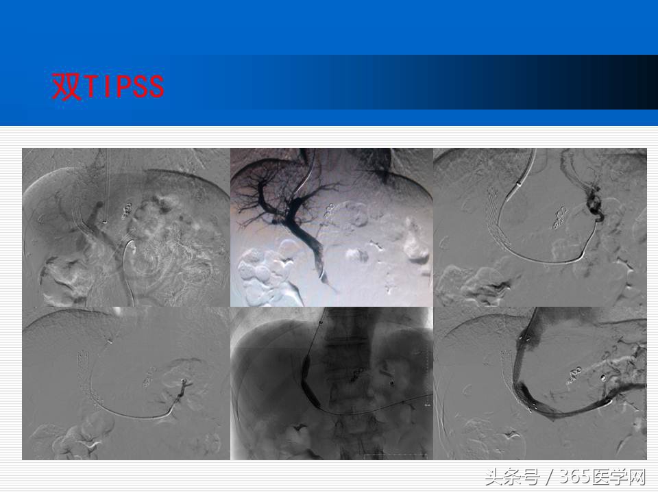 崔进国：消化道出血的介入治疗