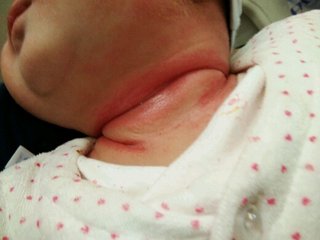 宝宝淹脖子导致破皮抹什么好得快,宝宝淹脖子擦红霉素软膏还是眼膏