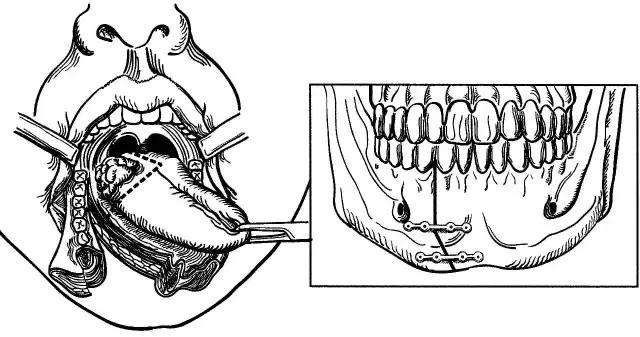 关于舌癌的新闻又一次刷屏，我想起了一年前离开的那位老人