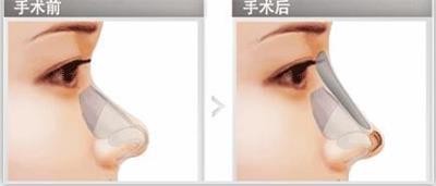 一招解决塌鼻子,教你三招摆脱塌鼻梁