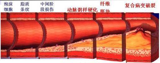 左侧股总动脉粥样斑块形成,吸烟造成动脉粥样斑块形成