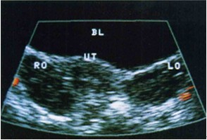 卵巢囊肿的b超描述,卵巢生理性囊肿的b超影像