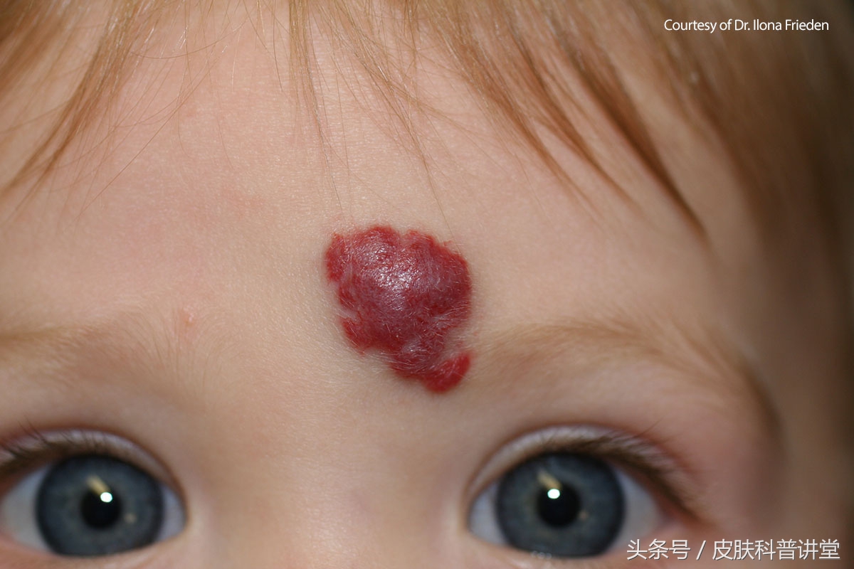 普萘洛尔治疗婴幼儿血管瘤的原因,普萘洛尔治疗血管瘤的注意事项