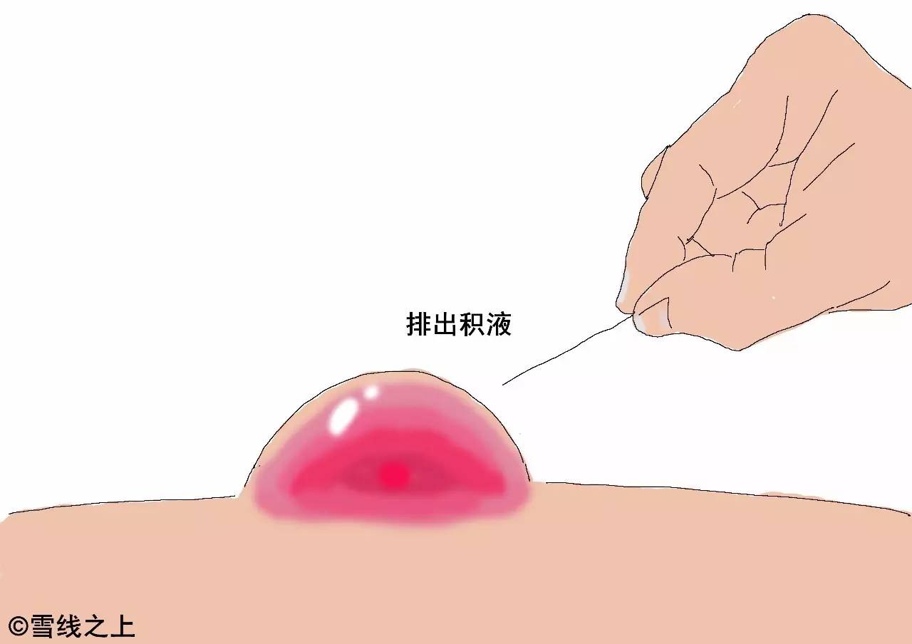 徒步走线时，如何防治水泡？