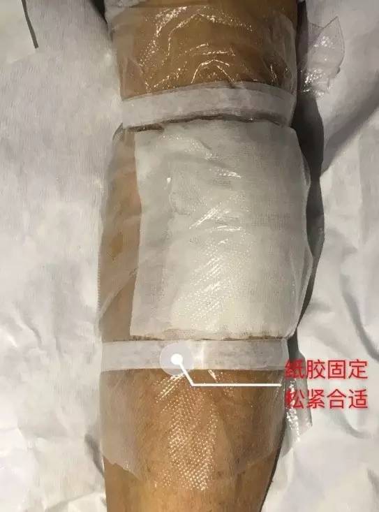 造影剂外渗用什么敷料,造影剂外渗后怎么处理