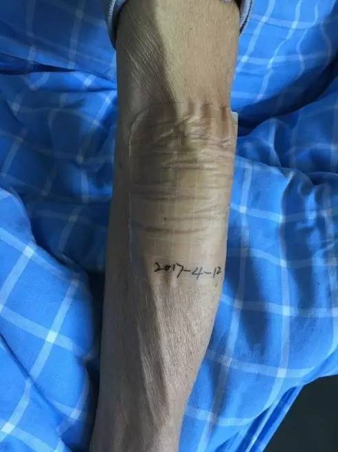 造影剂外渗用什么敷料,造影剂外渗后怎么处理