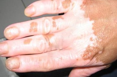 手上长白斑早期怎么预防,预防外阴白斑复发的方法是什么