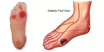 糖尿病足溃烂怎么治疗好得快,糖尿病足溃烂了一般怎么治疗