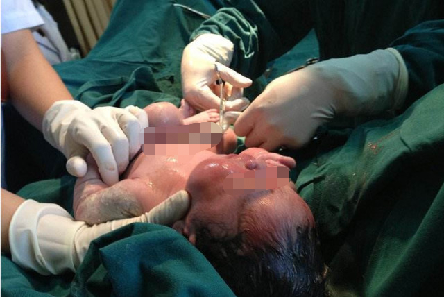 孩子生出来脐带一直不剪会窒息,孩子出生胎盘出来前剪脐带吗