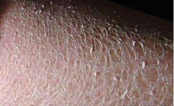 皮肤干燥脱皮起白屑是什么原因,皮肤干燥脱皮过敏怎么办