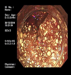 复发率高的最佳手术,复发后最佳挽救手术