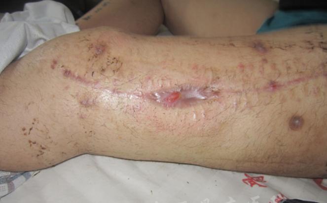 骨髓炎手术感染怎么办,中医治疗骨折方法