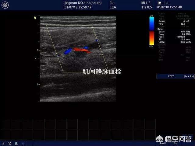 骨折术后下肢血栓好治吗,骨折术后怎样预防下肢静脉血栓