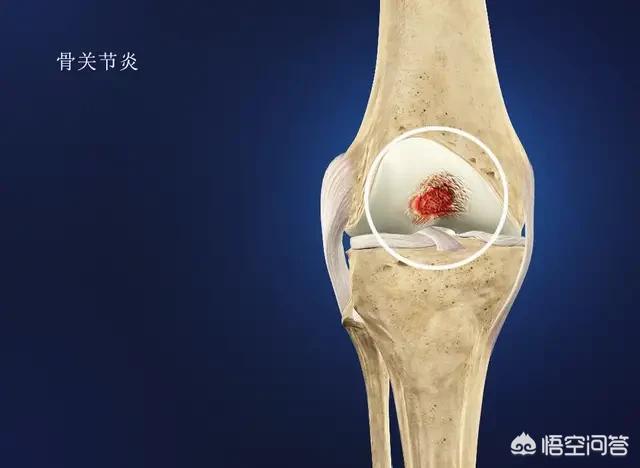 半月板撕裂手术后会有哪些症状,半月板撕裂时间长了可以做手术吗