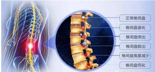 如何定位椎间盘位置,如何快速定位脊椎