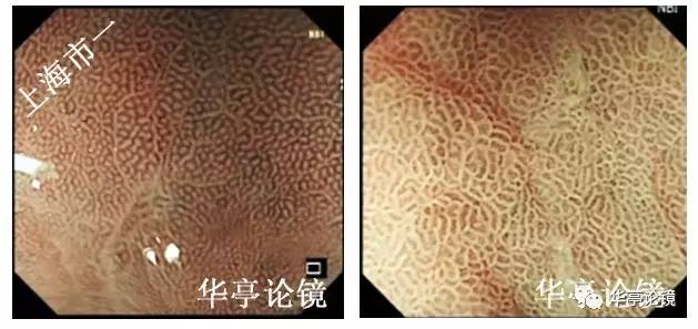 胃小灶癌变,胃体小凹型腺瘤