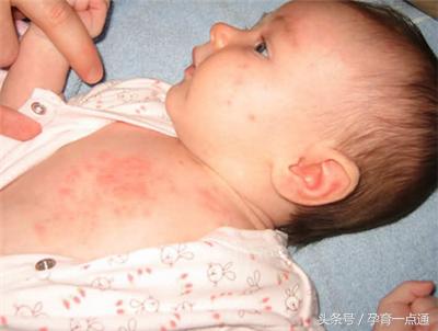 宝宝反复湿疹对付湿疹有妙招,宝宝湿疹和环境湿度