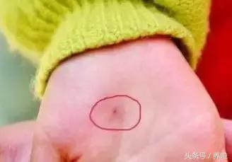 宝宝磕碰容易淤青怎么回事,宝宝磕碰肿淤青怎么处理