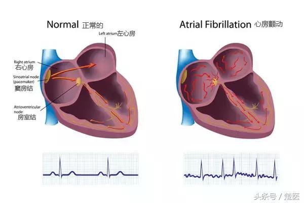 医生说|心要跳出来了怎么办?房颤最佳治疗在这里