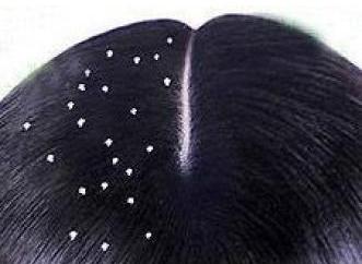 脂溢性脱发头皮瘙痒咋办,头皮痒脱发皮屑多咋治