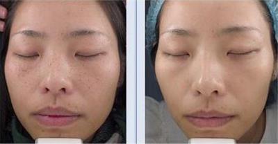 激光治疗祛雀斑,激光祛雀斑的最佳方法