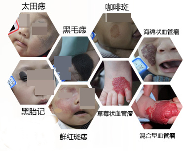 婴儿胎记是怎么形成的传说,婴幼儿胎记越来越深