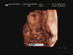 看懂孕期B超单,其实没有那么难!