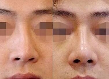 歪鼻子怎么办,歪鼻子有什么办法呢