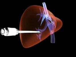 三分钟读懂介入治疗到底是啥