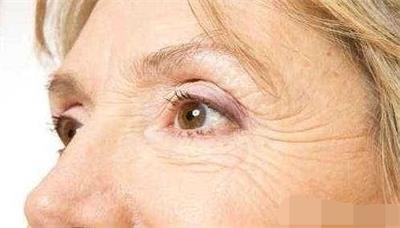 激光去除老年斑要多少钱,男人脸上老年斑去除方法