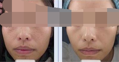 东莞激光祛雀斑效果如何,雀斑激光点阵有效果吗